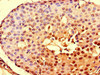 Immunohistochemistry of paraffin-embedded human breast cancer using CSB-PA892153LA01HU at dilution of 1:100