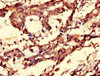 Immunohistochemistry of paraffin-embedded human gastric cancer using CSB-PA004810LA01HU at dilution of 1:100