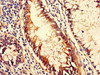 Immunohistochemistry of paraffin-embedded human colon cancer using CSB-PA004880LA01HU at dilution of 1:100