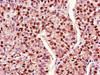 Immunohistochemistry of paraffin-embedded human liver cancer using CSB-PA013413LA01HU at dilution of 1:100