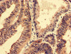Immunohistochemistry analysis of human colon cancer using CSB-PA021140LA01HU at dilution of 1:100