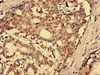 Immunohistochemistry analysis of human breast cancer using CSB-PA021140LA01HU at dilution of 1:100