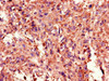 Immunohistochemistry of paraffin-embedded human melanoma using CSB-PA023116LA01HU at dilution of 1:100