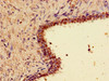 Immunohistochemistry of paraffin-embedded human prostate cancer using CSB-PA026141LA01HU at dilution of 1:100
