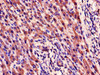 Immunohistochemistry of paraffin-embedded human liver cancer using CSB-PA10349A0Rb at dilution of 1:100