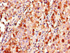 Immunohistochemistry of paraffin-embedded human lung cancer using CSB-PA12729A0Rb at dilution of 1:100