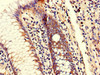 Immunohistochemistry of paraffin-embedded human colon cancer using CSB-PA617909LA01HU at dilution of 1:100 Immunohistochemistry of paraffin-embedded human colon cancer using CSB-PA617909LA01HU at dilution of 1:100