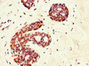 Immunohistochemistry of paraffin-embedded human breast cancer using CSB-PA764225LA01HU at dilution of 1:100 Immunohistochemistry of paraffin-embedded human breast cancer using CSB-PA764225LA01HU at dilution of 1:100