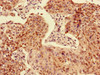 Immunohistochemistry of paraffin-embedded human cervical cancer using CSB-PA001266LA01HU at dilution of 1:100