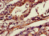 Immunohistochemistry of paraffin-embedded human gastric cancer using CSB-PA001837LA01HU at dilution of 1:100