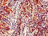 IHC image of CSB-PA004549LA01HU diluted at 1:700 and staining in paraffin-embedded human pancreatic cancer performed on a Leica BondTM system. After dewaxing and hydration, antigen retrieval was mediated by high pressure in a citrate buffer (pH 6.0) . Section was blocked with 10% normal goat serum 30min at RT. Then primary antibody (1% BSA) was incubated at 4°C overnight. The primary is detected by a biotinylated secondary antibody and visualized using an HRP conjugated SP system.