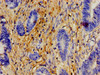 Immunohistochemistry of paraffin-embedded human colon cancer using CSB-PA007759LA01HU at dilution of 1:100