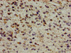 Immunohistochemistry of paraffin-embedded human glioma using CSB-PA007759LA01HU at dilution of 1:100