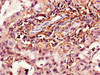 Immunohistochemistry of paraffin-embedded human lung cancer using CSB-PA010702LA01HU at dilution of 1:100