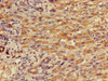 Immunohistochemistry of paraffin-embedded human liver cancer using CSB-PA011889LA01HU at dilution of 1:100
