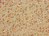 Immunohistochemistry of paraffin-embedded human glioma using CSB-PA013532LA01HU at dilution of 1:100 Immunohistochemistry of paraffin-embedded human glioma using CSB-PA013532LA01HU at dilution of 1:100