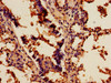 Immunohistochemistry of paraffin-embedded human lung cancer using CSB-PA020802LA01HU at dilution of 1:100