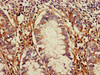 Immunohistochemistry of paraffin-embedded human colon cancer using CSB-PA023604LA01HU at dilution of 1:100