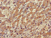 Immunohistochemistry of paraffin-embedded human liver cancer using CSB-PA05319A0Rb at dilution of 1:100