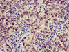 Immunohistochemistry of paraffin-embedded human pancreatic cancer using CSB-PA05319A0Rb at dilution of 1:100