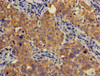 Immunohistochemistry of paraffin-embedded human pancreatic cancer using CSB-PA001853LA01HU at dilution of 1:100