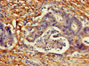Immunohistochemistry of paraffin-embedded human colon cancer using CSB-PA005094LA01HU at dilution of 1:100