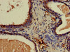 Immunohistochemistry of paraffin-embedded human prostate cancer using CSB-PA005657LA01HU at dilution of 1:100