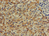 Immunohistochemistry of paraffin-embedded human liver cancer using CSB-PA006160LA01HU at dilution of 1:100