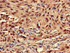 Immunohistochemistry of paraffin-embedded human lung cancer using CSB-PA012511LA01HU at dilution of 1:100