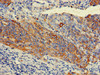 Immunohistochemistry of paraffin-embedded human cervical cancer using CSB-PA012564LA01HU at dilution of 1:100