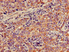 IHC image of CSB-PA013409LA01HU diluted at 1:300 and staining in paraffin-embedded human pancreatic cancer performed on a Leica BondTM system. After dewaxing and hydration, antigen retrieval was mediated by high pressure in a citrate buffer (pH 6.0) . Section was blocked with 10% normal goat serum 30min at RT. Then primary antibody (1% BSA) was incubated at 4°C overnight. The primary is detected by a biotinylated secondary antibody and visualized using an HRP conjugated SP system.