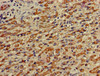 Immunohistochemistry of paraffin-embedded human liver cancer using CSB-PA013714LA01HU at dilution of 1:100