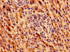 Immunohistochemistry of paraffin-embedded human liver cancer using CSB-PA015197LA01HU at dilution of 1:100