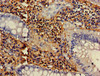Immunohistochemistry of paraffin-embedded human colon cancer using CSB-PA015525LA01HU at dilution of 1:100