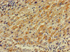 Immunohistochemistry of paraffin-embedded human liver cancer using CSB-PA018085LA01HU at dilution of 1:100