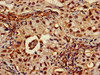 Immunohistochemistry of paraffin-embedded human lung cancer using CSB-PA020088LA01HU at dilution of 1:100