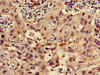Immunohistochemistry of paraffin-embedded human lung cancer using CSB-PA020372LA01HU at dilution of 1:100