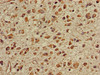 Immunohistochemistry of paraffin-embedded human glioma using CSB-PA023444LA01HU at dilution of 1:100