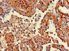 Immunohistochemistry of paraffin-embedded human lung cancer using CSB-PA026138LA01HU at dilution of 1:100 Immunohistochemistry of paraffin-embedded human lung cancer using CSB-PA026138LA01HU at dilution of 1:100