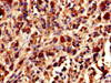 Immunohistochemistry of paraffin-embedded human melanoma using CSB-PA026233HA01HU at dilution of 1:100