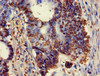 Immunohistochemistry of paraffin-embedded human colon cancer using CSB-PA026233HA01HU at dilution of 1:100