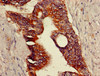Immunohistochemistry of paraffin-embedded human colon cancer using CSB-PA822774LA01HU at dilution of 1:100
