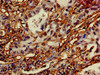 Immunohistochemistry of paraffin-embedded human lung cancer using CSB-PA836675LA01HU at dilution of 1:100