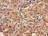 Immunohistochemistry of paraffin-embedded human lung cancer using CSB-PA842635LA01HU at dilution of 1:100