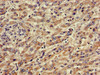 Immunohistochemistry of paraffin-embedded human liver cancer using CSB-PA845163LA01HU at dilution of 1:100