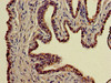 Immunohistochemistry of paraffin-embedded human prostate cancer using CSB-PA845172LA01HU at dilution of 1:100