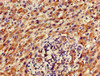 Immunohistochemistry of paraffin-embedded human liver cancer using CSB-PA853484LA01HU at dilution of 1:100