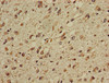 Immunohistochemistry of paraffin-embedded human glioma using CSB-PA855048LA01HU at dilution of 1:100