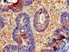 Immunohistochemistry of paraffin-embedded human ovarian cancer using CSB-PA857873LA01HU at dilution of 1:100