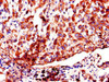 Immunohistochemistry of paraffin-embedded human lung cancer using CSB-PA857882LA01HU at dilution of 1:100